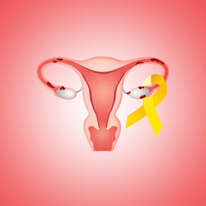 Utérus atteint d'une endométriose que le complément alimentaire EDM Pack permet de traiter naturellement